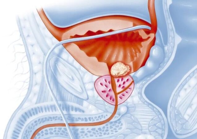 Značajke kroničnog oblika prostatitisa