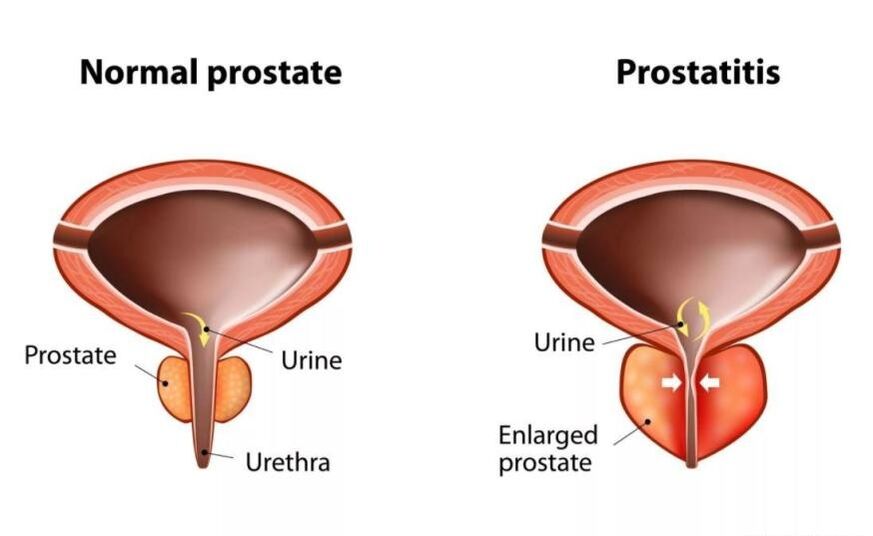 Normalna prostata i upaljena