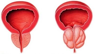 Zdrava i upaljena prostata prostatitisom